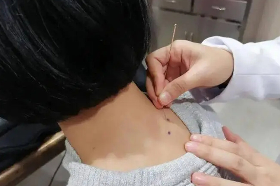 北京特效针刺治疗骨头坏死